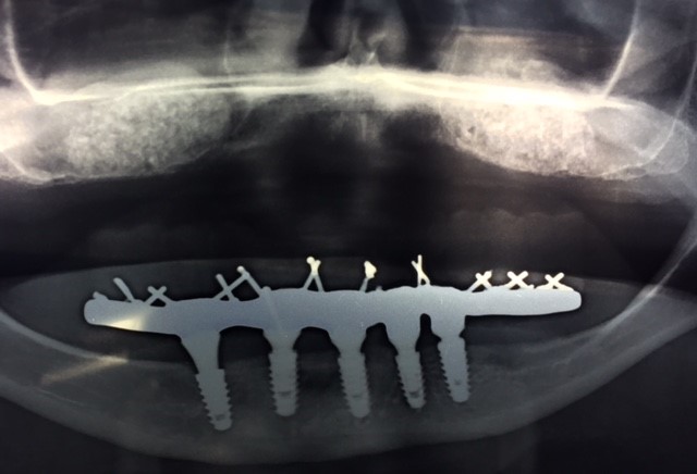 Tratamento Acesso Lateral com Enxerto - Clínica Odontológica Alex Albanese - Dentista em Conselheiro Lafaiete