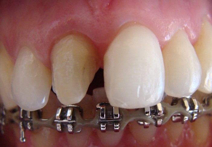 Tratamento Reabilitação sobre Dentes Naturais